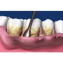 Periodoncia