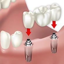 Implantes Dentales